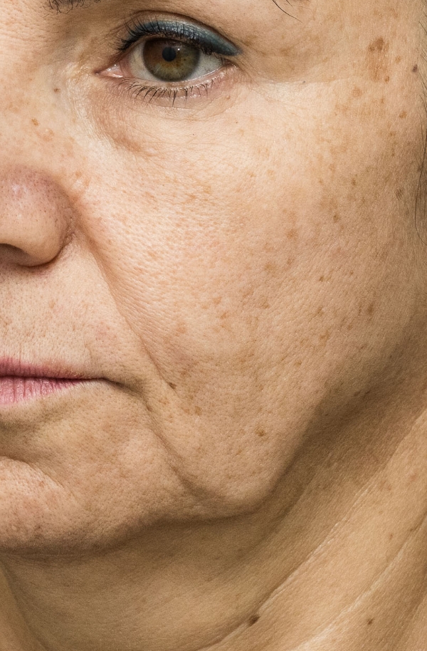 Jowls