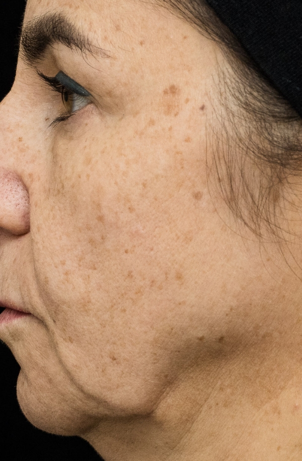 Hyper­pigmentation