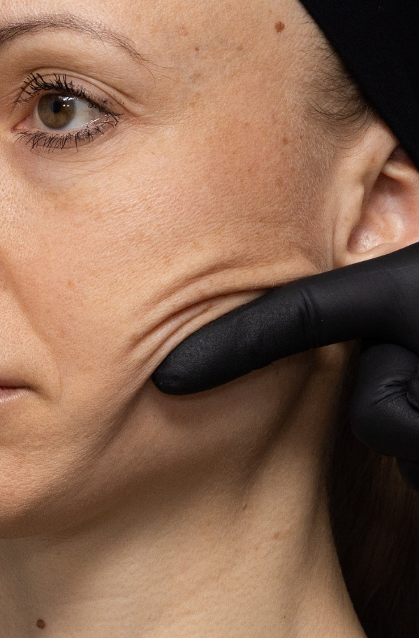 Skin rejuvenation