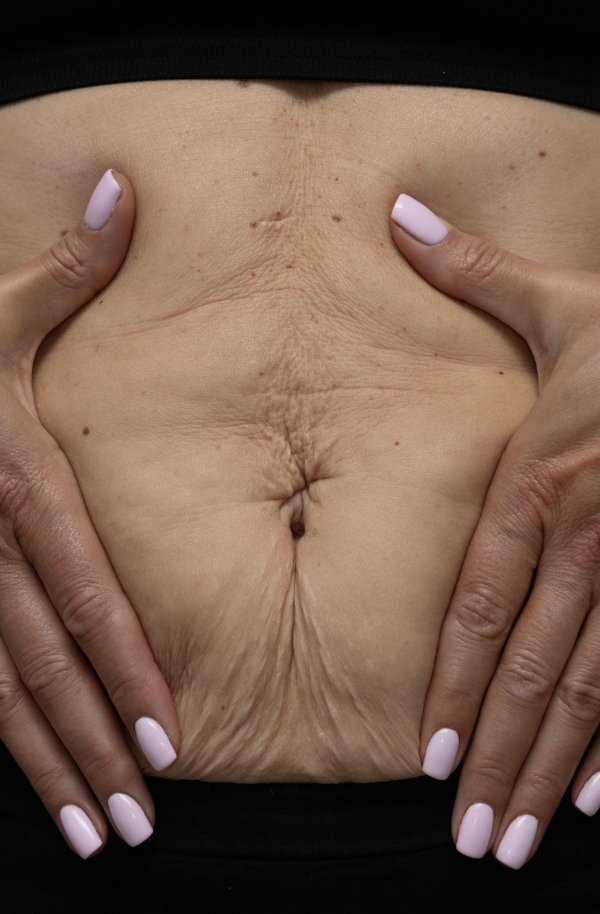 Stretch marks
